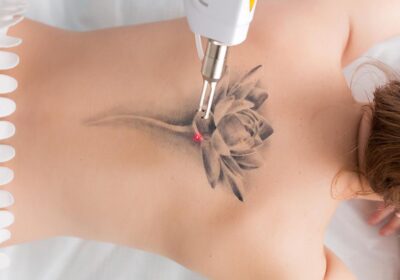 5 Facts About Tattoo Removals You May Not Know About!